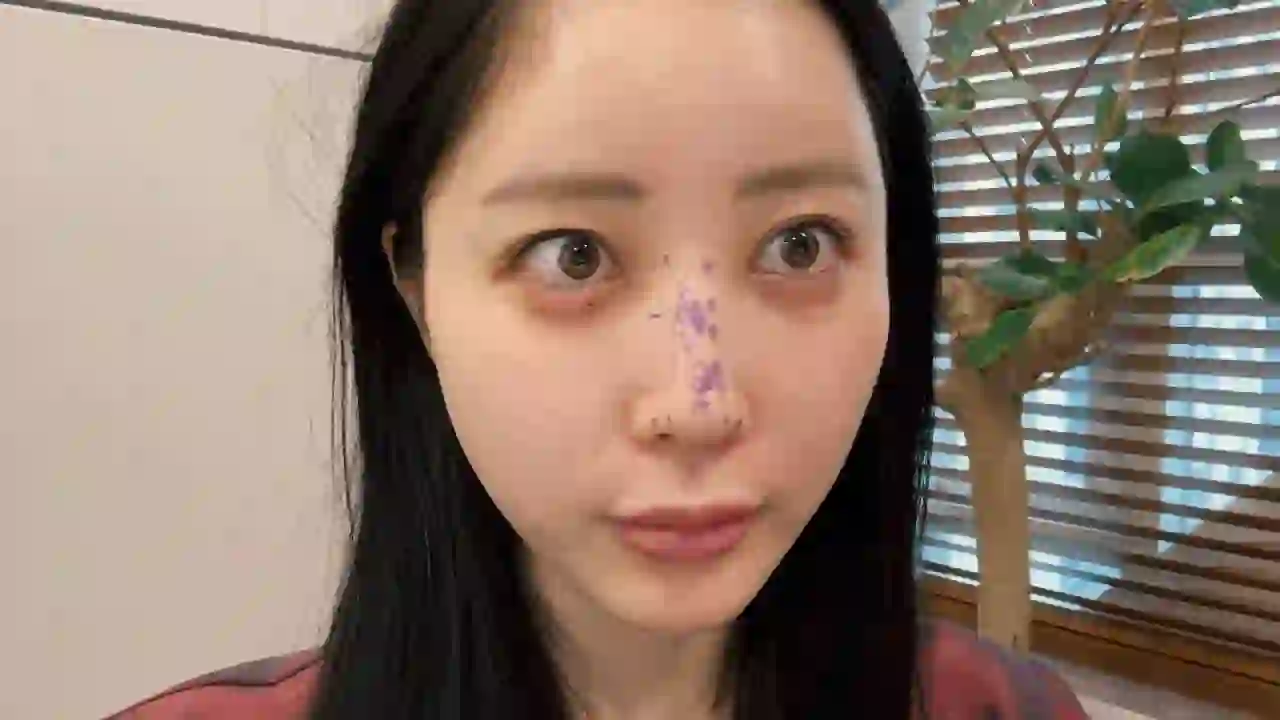【Nose Surgery】Fukurena finally had nose surgery. First time revealing the downtime!!